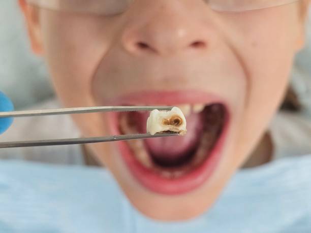 Best Emergency Treatment for Dental Infections or Abscesses in Maltby, WA