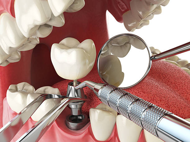 Best Emergency Root Canal Treatment in Maltby, WA